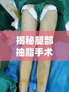 揭秘腿部抽脂手术价格真相!